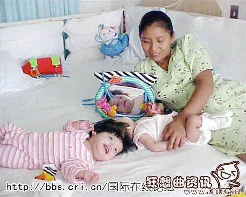 美国加利福尼亚州的一所儿童医院，勒蒂西亚·道恩·阿尔瓦勒兹正陪着她的连体双胞胎女儿玩耍。2002年8月6日，这对双胞胎成功接受了分离手术。