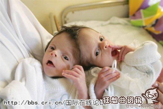 近年来，世界各地都出现有关连体双胞胎的报道，每次都能吸引很多人关注的目光。通过手术，报道中提到的一些连体双胞胎成功分离。连体姐妹花艾比·亨瑟尔和布列塔尼·亨瑟尔。