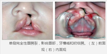 【科学姐】李嫣兔唇这事儿 真不能全怪王菲