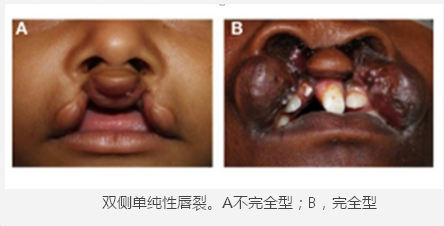 按照发育缺陷上来分为:单侧唇和/或腭裂,也可以是双侧性唇和/或腭裂