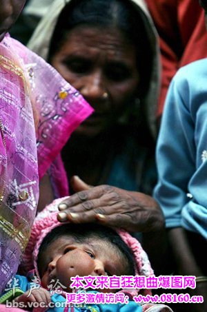 印度妇女产下双面女婴，双面女婴太神奇了！
